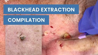 Extraction Satisfaction Blackhead Removal  CONTOUR DERMATOLOGY [upl. by Emarej]