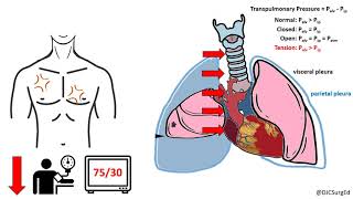 Thoracic Trauma [upl. by Denny16]