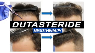 Mesotherapy with Dutasteride Injections Pros and Cons and what Results to expect [upl. by Warfield]