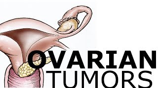 Ovarian Pathology amp Tumors [upl. by Lamrouex]