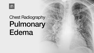 Chest Radiography Pulmonary Edema [upl. by Aisyat433]