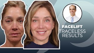 10 YEARS YOUNGER Traceless Facelift Surgery Before and After  Dr David Stoker [upl. by Ytitsahc284]