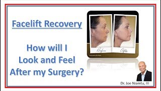 Facelift Recovery How will I Look and feel after my surgery [upl. by Amliw82]