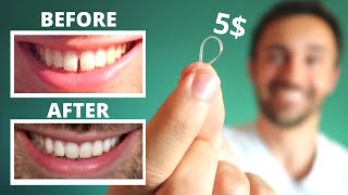 DIY CLOSE GAP TEETH AT HOME  My Update [upl. by Ettari366]