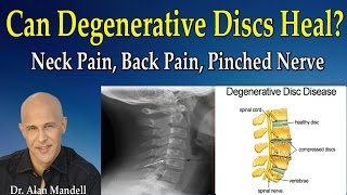 Can Degenerative Discs Heal Normal Again Neck Pain Back Pain Pinched Nerve  Dr Mandell [upl. by Urbanus]