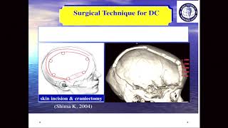 INRCAmsterdam 2018 Decompressive Craniectomy for Trauma by Professor Tariq Khan [upl. by Auqinu244]