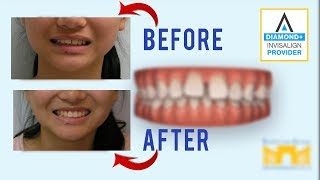 Invisalign Before and After Gap in Teeth [upl. by Fonville]