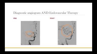 AANS Coding Shorts Middle Cerebral Artery Thrombectomy [upl. by Navlys978]