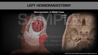 Left Hemicraniectomy  Medical Animation [upl. by Erdman]