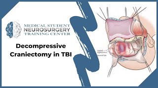 Decompressive Craniectomy in TBI [upl. by Areik]