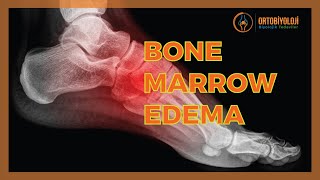 BONE MARROW EDEMA TREATMENTS [upl. by Adnohsad912]