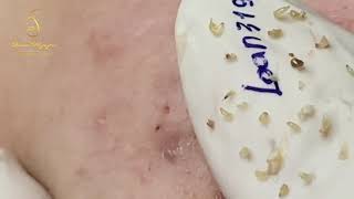 Blackheads removal 319  Loan Nguyen [upl. by Eindys]