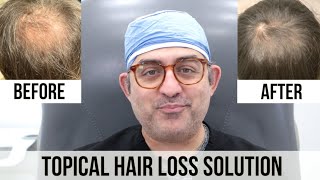 Topical Finasteride and Minoxidil HAIR LOSS Solution [upl. by Aennyl]