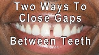 How to Close Gaps Between Teeth [upl. by Akihsat241]