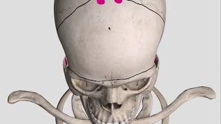 Bifrontal decompressive craniectomy bony cuts [upl. by Vinny129]