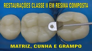 Restauração Classe II em Resina Composta  PARTE 1 [upl. by Mehala462]