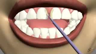 gap closure by dental veneers [upl. by Eltsirk]