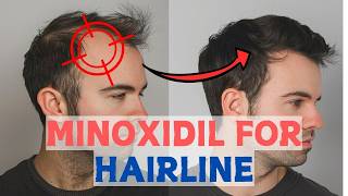 Minoxidil for Frontal Baldness  Restore Your Hairline [upl. by Tomas236]