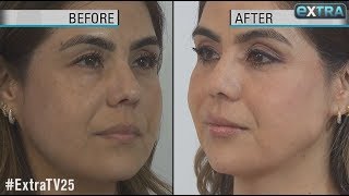 How to Get a Quick FaceLift Without Surgery [upl. by Macri40]