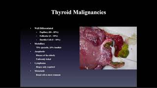 Thyroid Surgery [upl. by Sall]