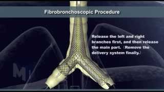 Tracheal Stent [upl. by Reltuc137]