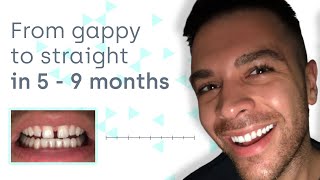 How to close teeth gaps safely and invisibly at home [upl. by Ndnarb]