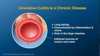 Understanding Ulcerative Colitis  Jumo Health [upl. by Drannek104]