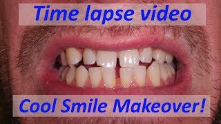 Time lapse of Dental Composite Veneers to close gaps [upl. by Einaej]