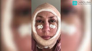 Upper and Lower Blepharoplasty and Mini Facelift Vlog [upl. by Smail36]