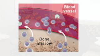 Considerations for Autologous Stem Cell Transplantation [upl. by Dinan]