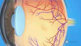 What is cystoid macular edema [upl. by Enoek471]