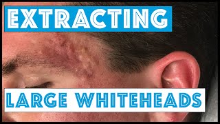 Acne Vulgaris and Extracting large Whiteheads  Part 1 [upl. by Publius]