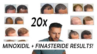 20 Finasteride and Minoxidil before and after Results NW2  NW56 [upl. by Lessirg248]