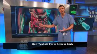 How Typhoid Fever Affects the Body  The Doctors [upl. by Rondon]