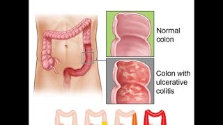 Ulcerative Colitis [upl. by Leimad693]