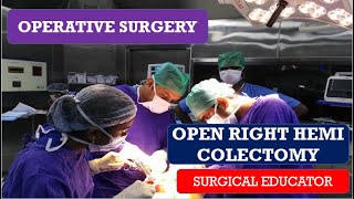 OPEN RIGHT HEMICOLECTOMY STEP BY STEP OPERATIVE SURGERY [upl. by Audrie]