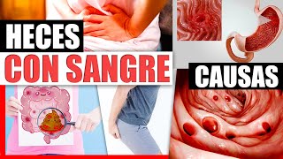 Sangre En Las Heces  Causas Y Tratamiento Natural Para Hemorroides Diverticulitis Ulceras Y Mas [upl. by Laekcim374]