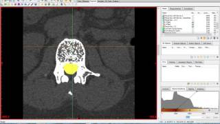 Materialise Mimics and 3Matic Tutorial [upl. by Panaggio481]