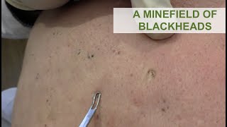 A Minefield of Blackheads  Dr Derm [upl. by Seiden707]