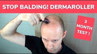 STOP BALDING  Dermaroller 3 Month Test and Tutorial [upl. by Otrebmuh]