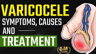 Varicocele Symptoms Causes and Treatment  Varicocele Natural Treatment  Testis Pain Relief [upl. by Enialahs988]