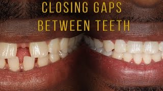 Closing Gaps Between Teeth With Braces [upl. by Adiehsar]