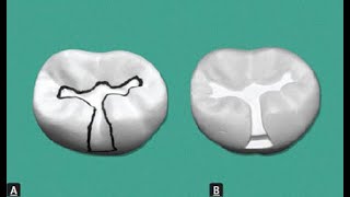 Class 1 buccal extension [upl. by Inness]