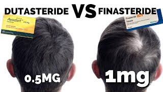 Dutasteride Mega Guide  Better Than Finasteride [upl. by Vinn934]