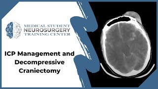 ICP Management and Decompressive Craniectomy [upl. by Eiro]