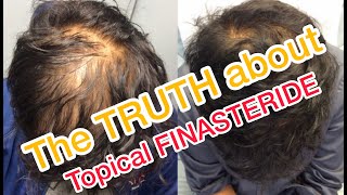 Topical Finasteride  Minoxidil results after 6 Months [upl. by Anemolihp]