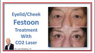 Festoon Treatment with CO2 Laser [upl. by Jefferson]