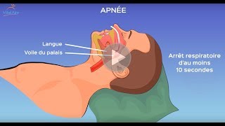 L’apnée du sommeil qu’estce que c’est [upl. by Arreis]