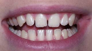 How to fix the gaps in your teethsmile  Dentist in Skelmersdale [upl. by Circosta57]