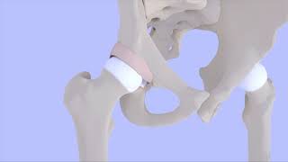 Femoroacetabular Impingement Syndrome [upl. by Nohsyt]